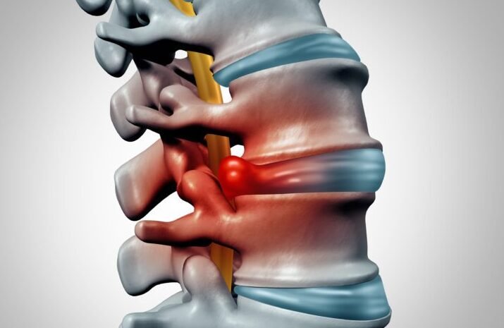 Spinal Disc Injury