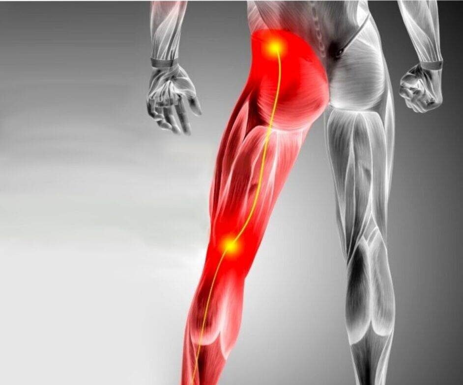 Sciatica Treatment